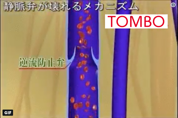 TOMBO = 静脈サポート